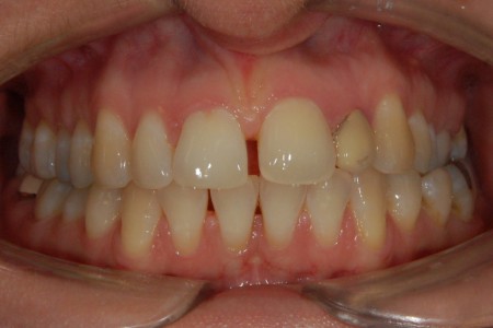 Diastema- stav před léčbou